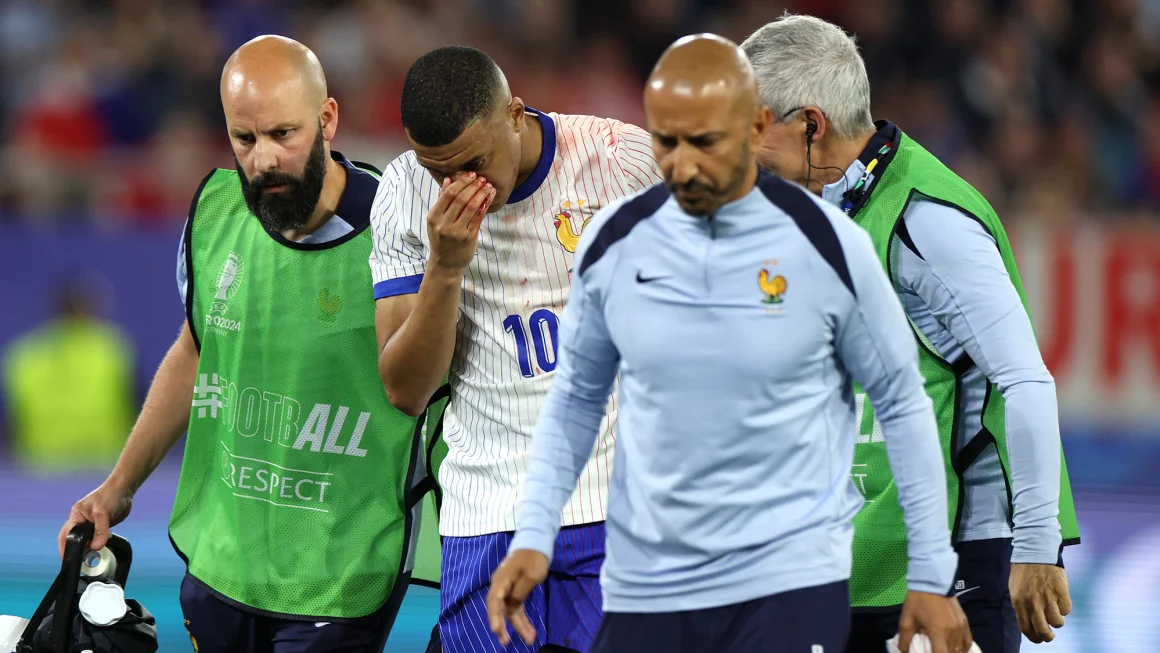 Kapten Prancis Kylian Mbappé menderita patah hidung dalam kemenangan Euro 2024